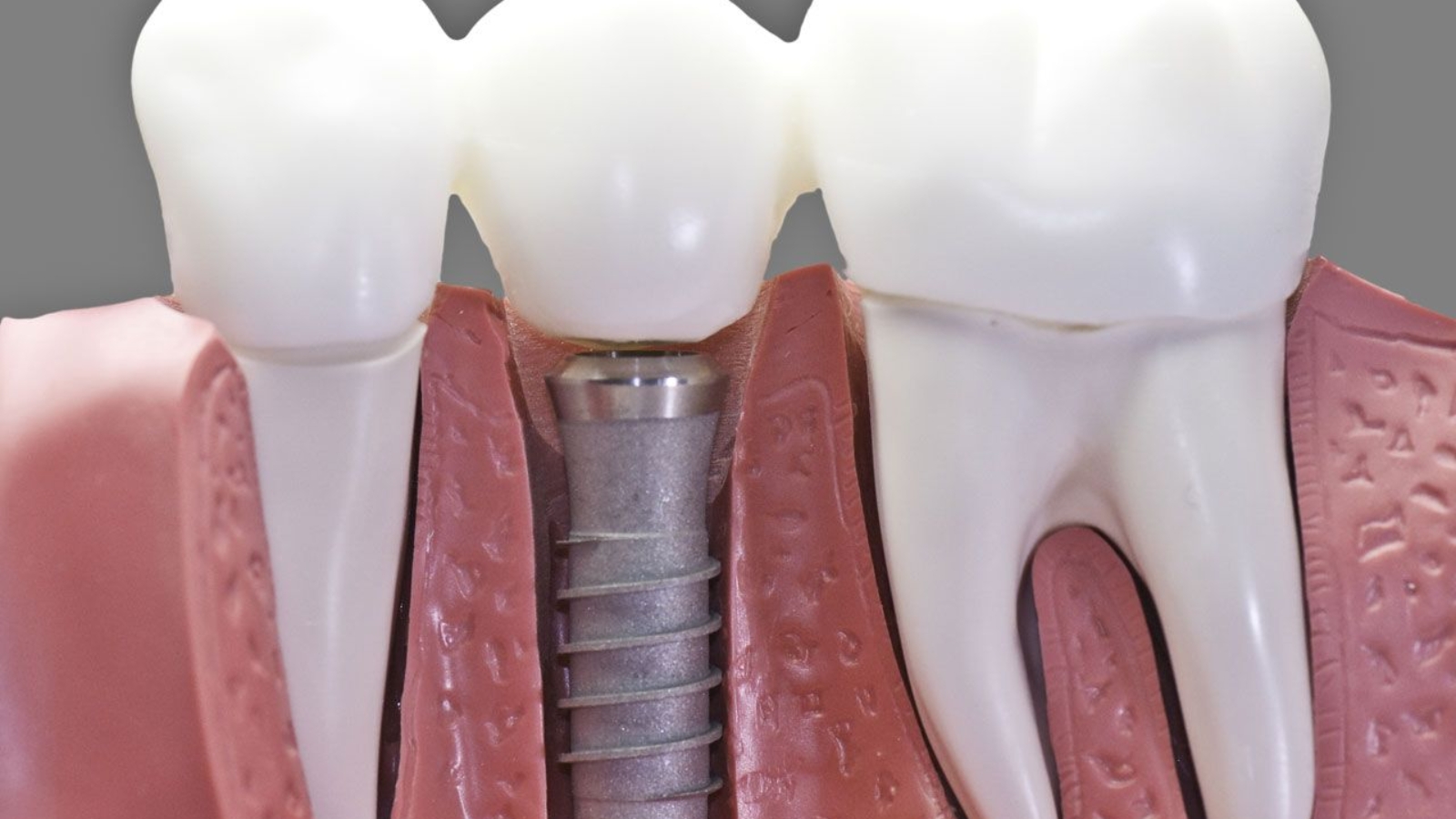 What-is-a-Dental-Implant-on-How-Does-It-Work.jpg